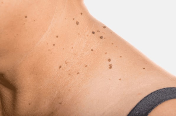Are you looking for easy skin tag removal Holme Chapel - then contact Spire today!