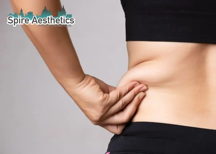 Image of woman pinching fat on their hips Holme Chapel. Fat Freezing treatment