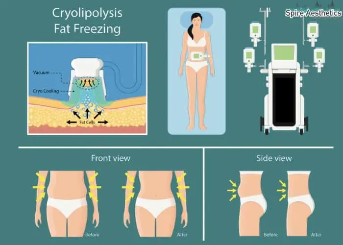 Fat freezing treatment Holme Chapel benefits for competitions to remove stubborn fat deposits.