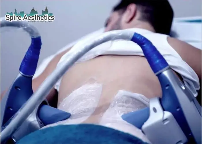 Man having fat freezing treatment done on love handles before a competitions Holme Chapel to create a sculpted look.
