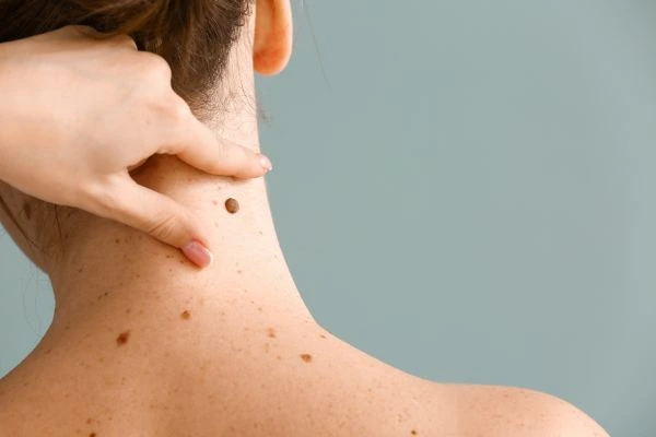skin blemish removal Holme Chapel treatment